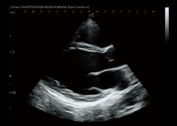 Left ventricular long axis, B Mode