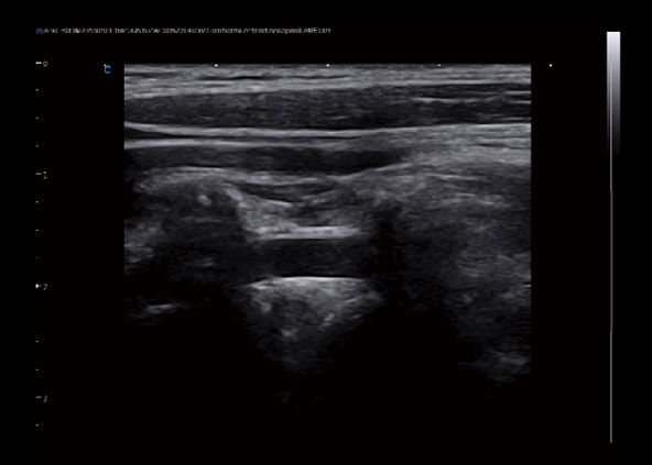 Vertebral Artery, B Mode