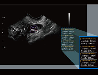 Auto Follicle Detection,B Mode