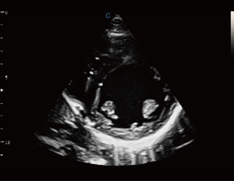 Pediatric Cerebral Tumor,B Mode