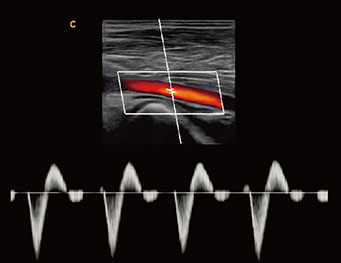 Femoral Artery, PW Mode