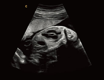 Fetal Heart,B Mode