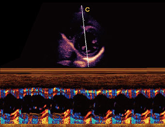 Papillary Muscle Short Axis,B Mode