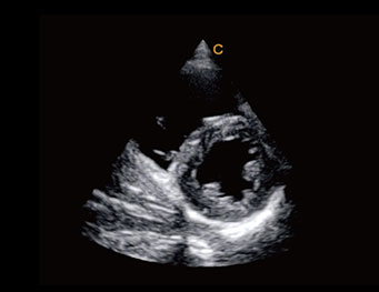 Papillary Muscles, TDI M Mode