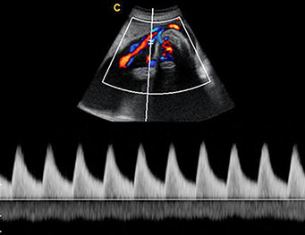 Umbilical Cord, PW Mode