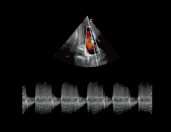 Cardiac Two Chambers,CW Mode