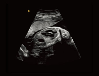 Fetal Heart,B Mode