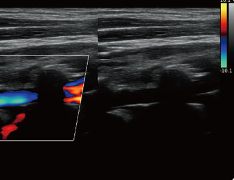 Vertebral Vessel,B/BC Mode