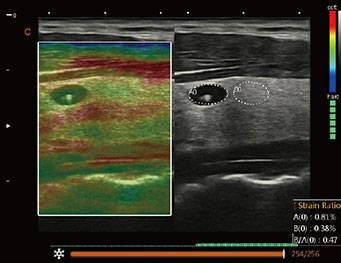 Thyroid, Elastography