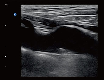 Carotid Plaque, B Mode