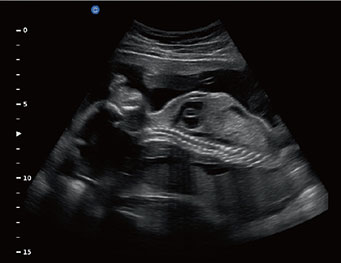 Fetal Heart, B Mode