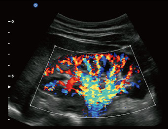 Kidney, C Mode