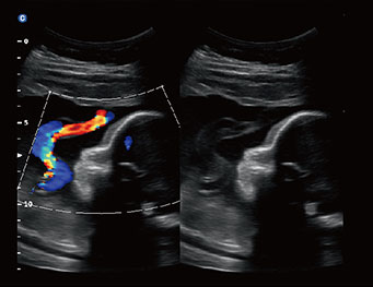 Umbillical Cord, B or BC Mode