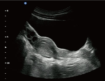 Uterus, B Mode