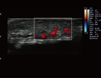 Popliteal Artery and Vein