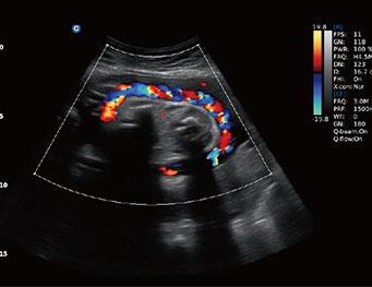 Umbilical cord, C Mode