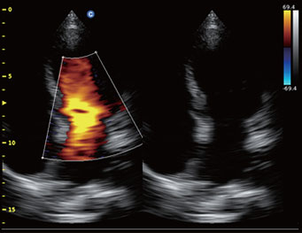 Cardiac, B orBC Mode