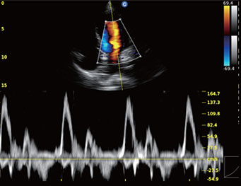 Cardiac, PW Mode