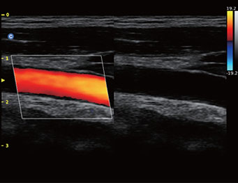 Carotid, B or BC Mode