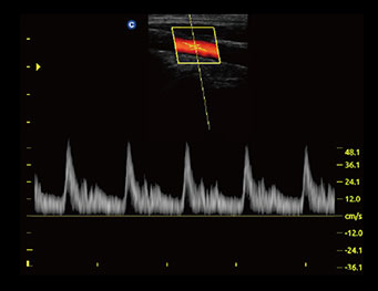 Carotid Artery, D Mode