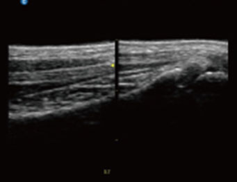 Palmaris Longus Tendon,B Mode