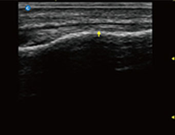 Patella Tendon Tibian Insertion Part, B Mode