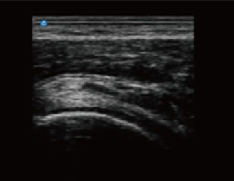 Subscapularis Tendon,B Mode