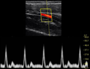 Ulnar Artery,PW Mode