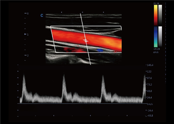 Doppler inteligente