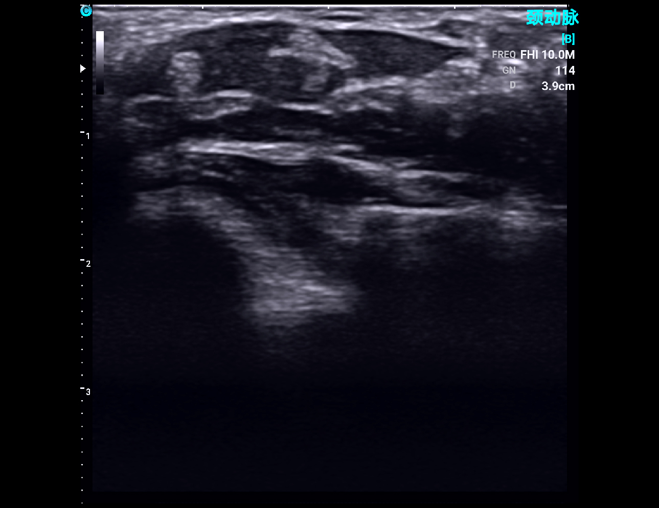 Wrist tendon, B Mode