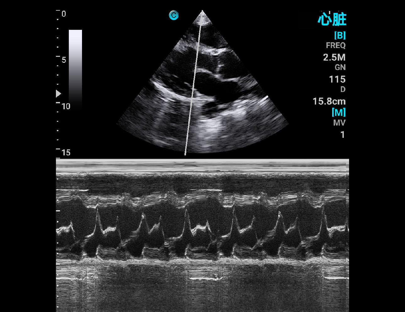 Cardiac, M Mode