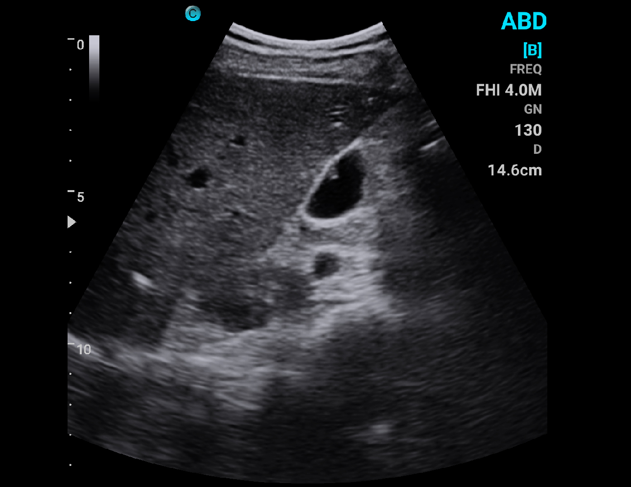 Gallbladder Polyps, B Mode